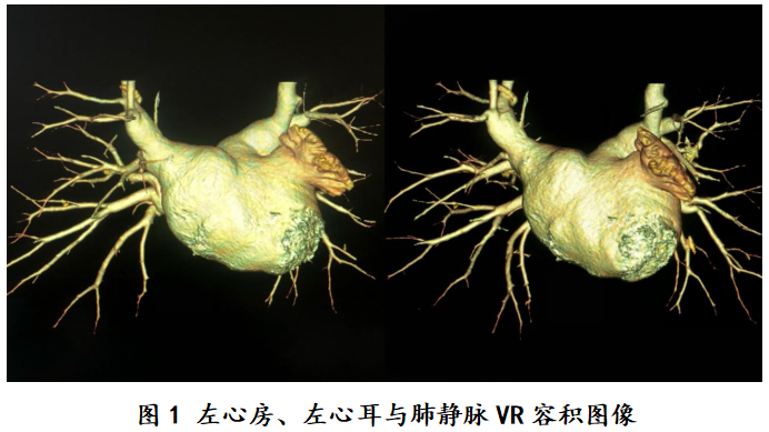 左上肺静脉图片