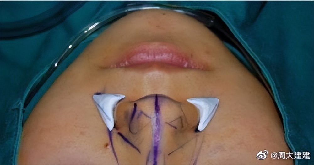 哑铃鼻基底,新术式不移位,郑州周建医生鼻整形专访