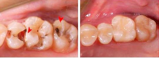 别拿"龋洞"开玩笑,再不治疗会变成牙髓炎!(特别是宝宝)