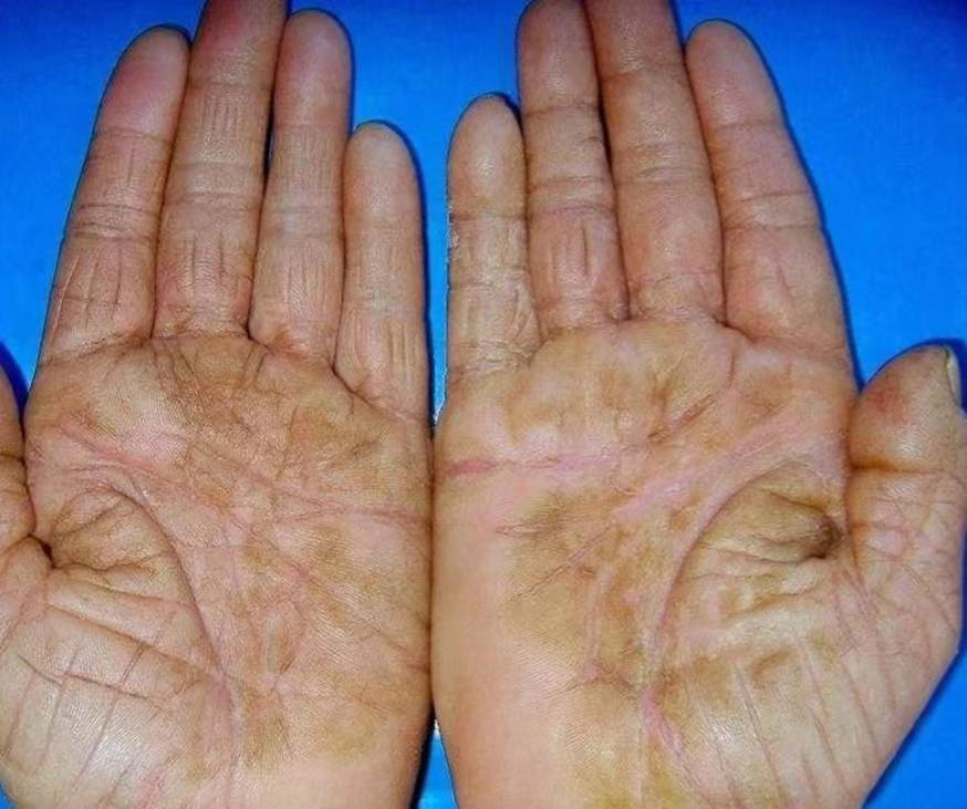 人到中年满手干裂怎么办?教你在家就能解决,3天手就光滑了!