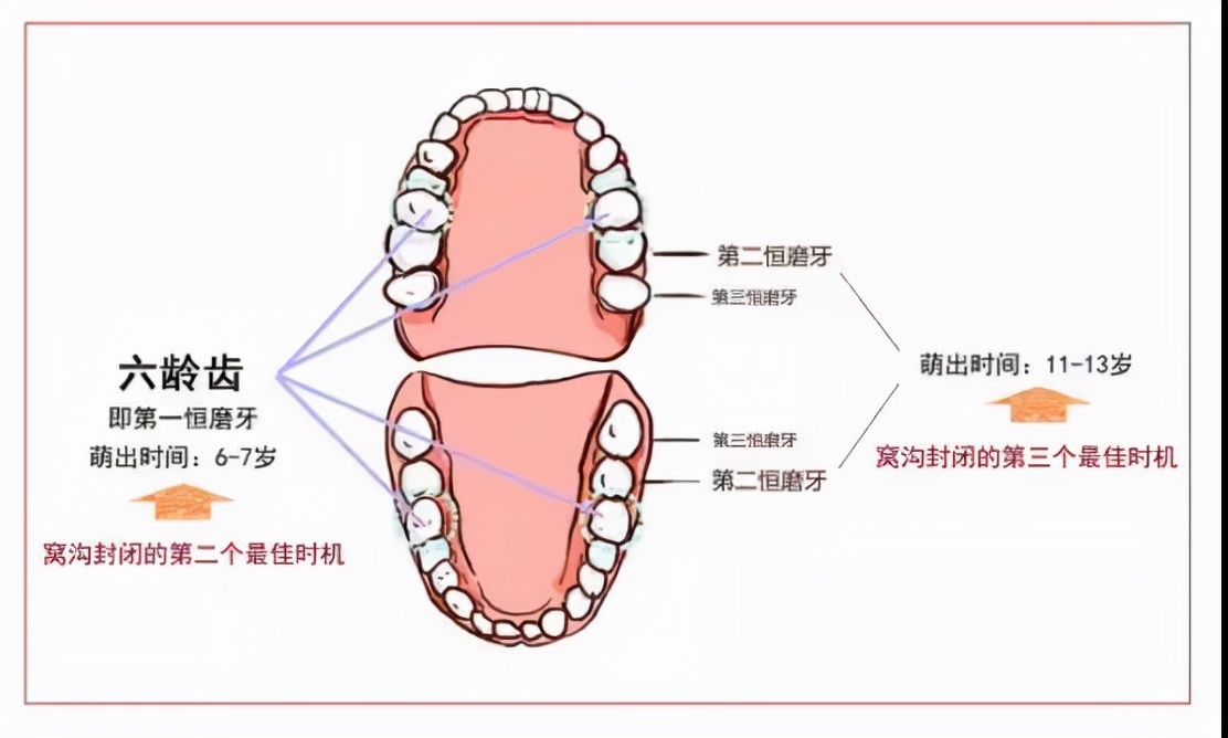 儿童窝沟封闭值得做吗?几十块钱不到,预防恒磨牙龋最有效方法