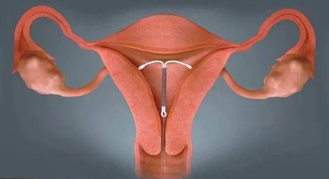 医生把这个环"缝"在了患者子宫里