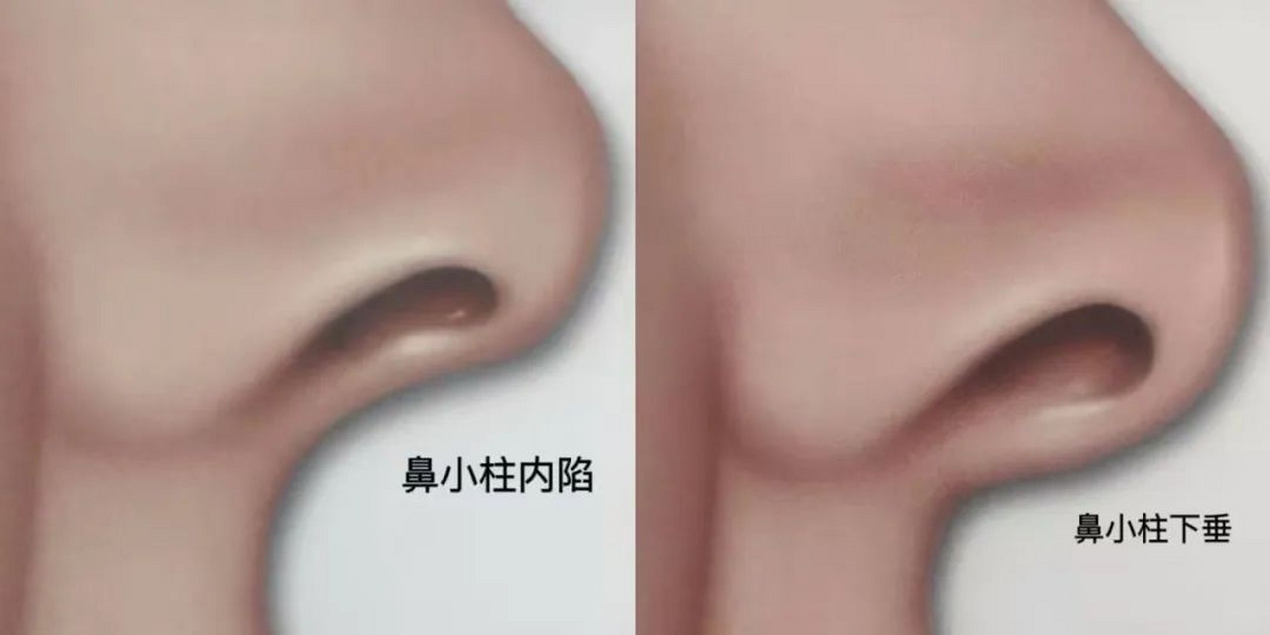 鼻小柱通常不会被大家注意到,因为对这个部位不是很了解,但是鼻小柱在