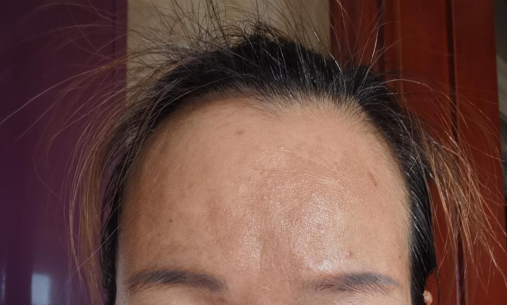 当我们看到额头上出现了黑色素沉淀时,首先要做的就是保持肌肤的清洁.