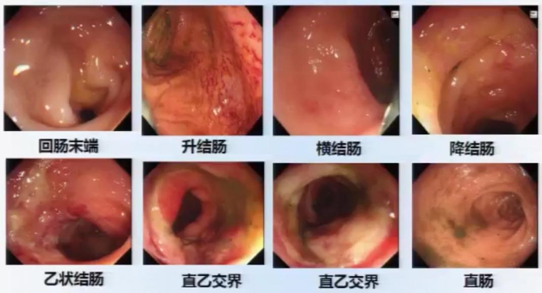 女性乙状结肠炎的症状图片