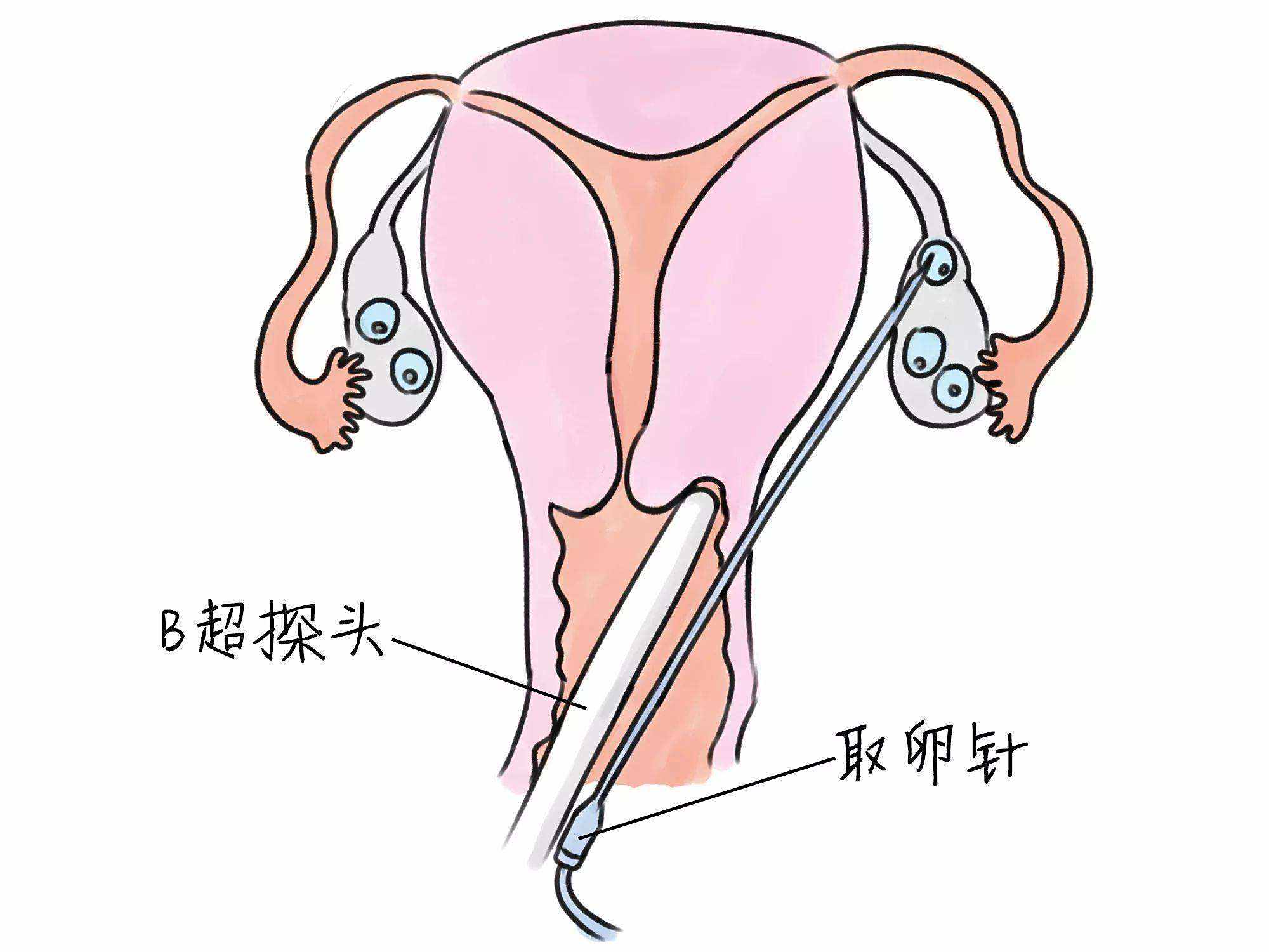 什么叫取卵手术_取卵是什么样的手术  第2张