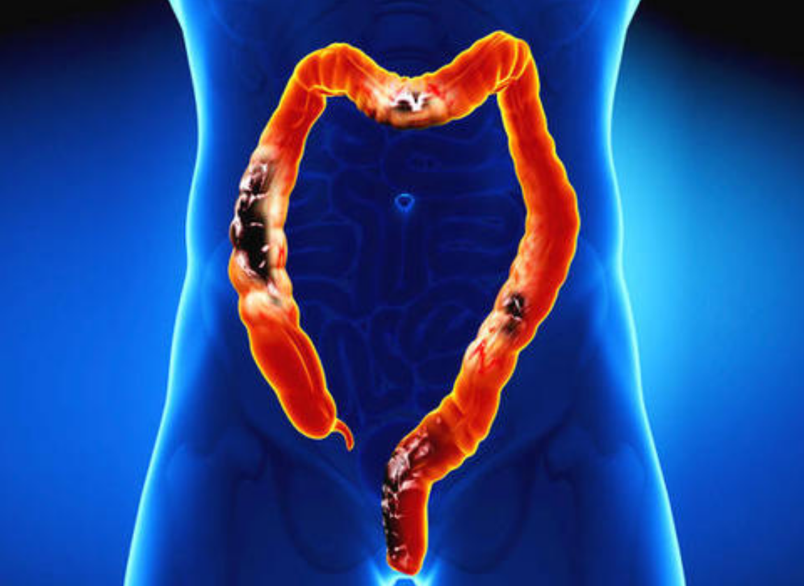 肠胃功能紊乱身体或有5个症状占其一肠胃或已生病