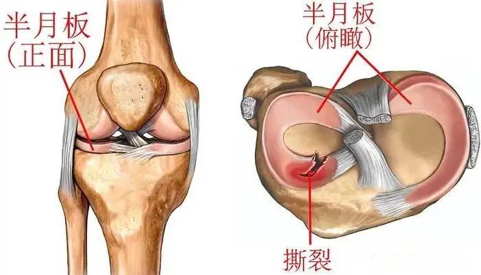 半月板损伤的位置图片图片