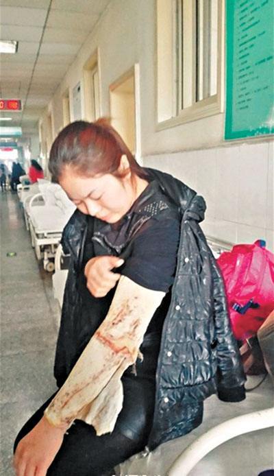 2015年,河南男子掉进油锅被烫熟,妻子捐"人皮外衣",结局如何