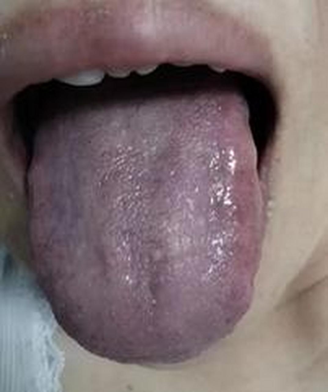 舌头胖大,舌质发紫,我们该如何调理?
