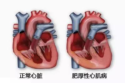 心肌炎是一种由多种致病微生物引起的炎症反应,可累及整个心脏