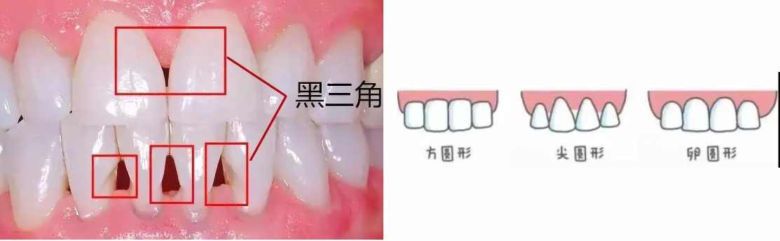 昆明牙科健康科普:什么叫牙齿黑三角?牙齿黑三角怎么形成的?