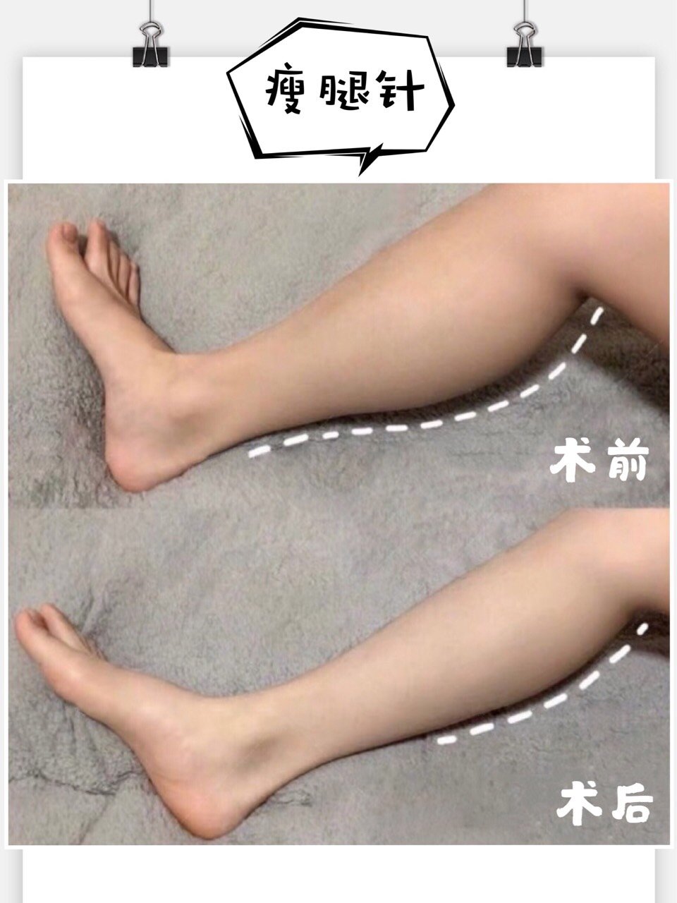 夏天别只关注瘦腿,瘦腿针调整配比,对瘦肩也有帮助哦