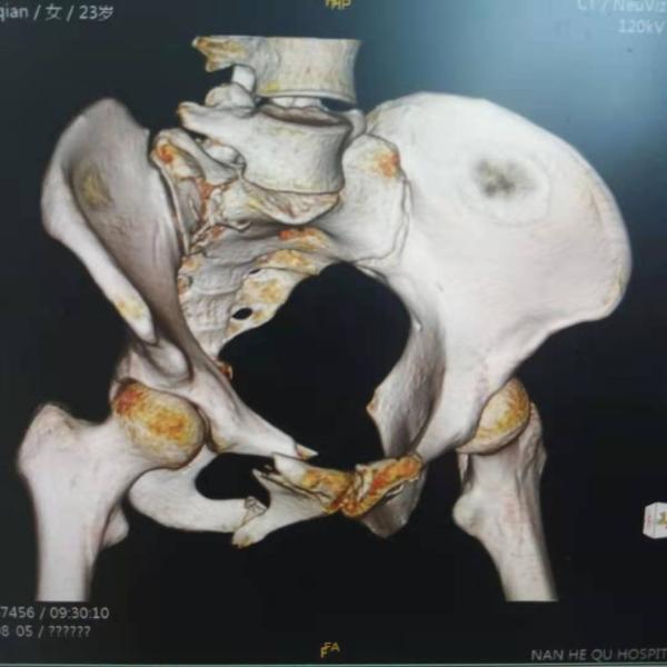黃豆大的切口,一枚髓內釘成功治療恥骨骨折