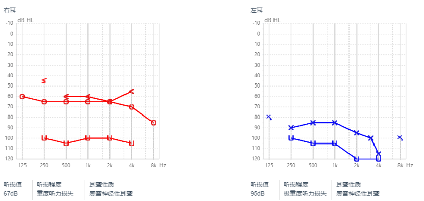 听力图怎么看?白话翻译验配师专业术语