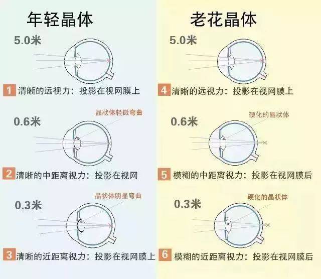 白内障自测图年轻人图片