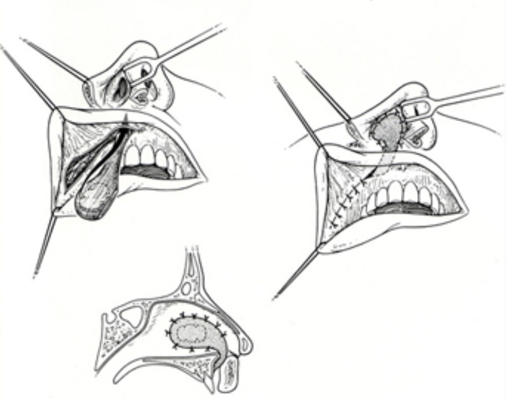 创伤性鼻中隔穿孔,多由头,面,鼻部外伤引起,可能并发嗅觉减退