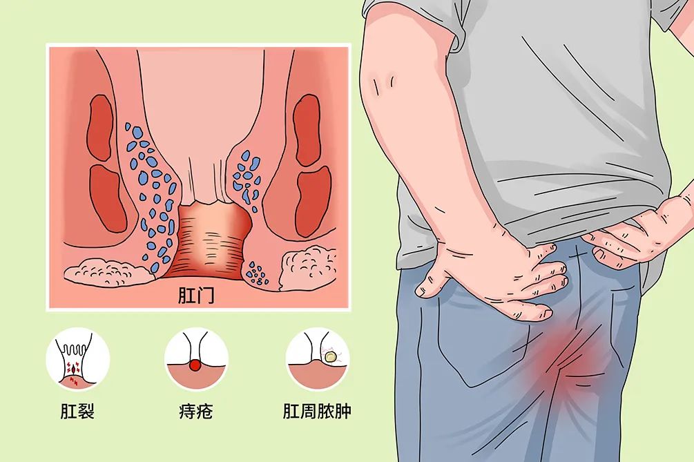 肛门坠胀屁多图片