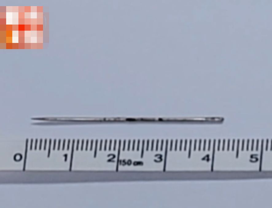 痛心!西安5个月大女婴心脏被绣花针扎进,医生猜测有两种可能