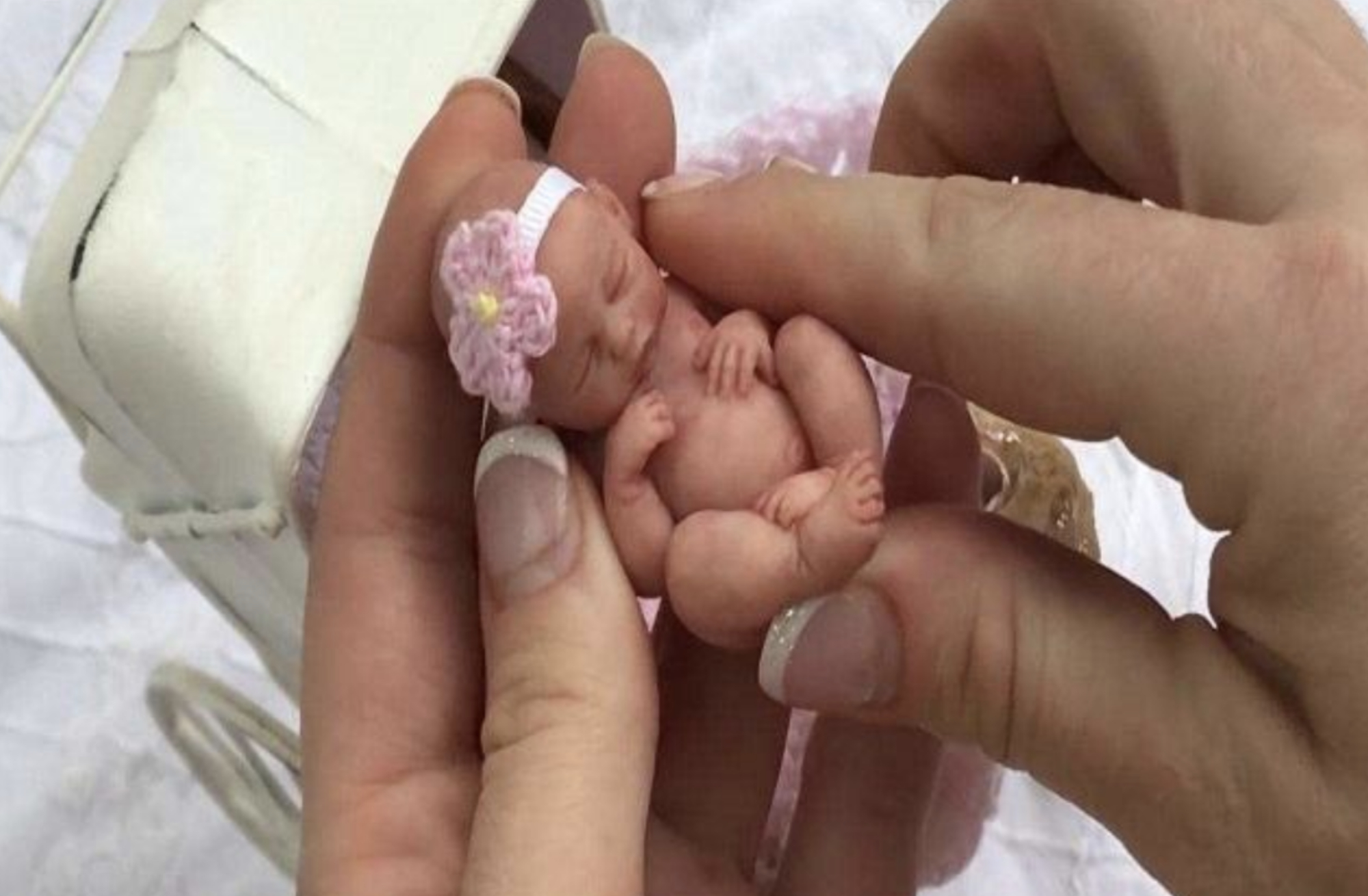 15年过去了,那个出生体重仅0.56斤的世界最小婴儿,如今怎样了?