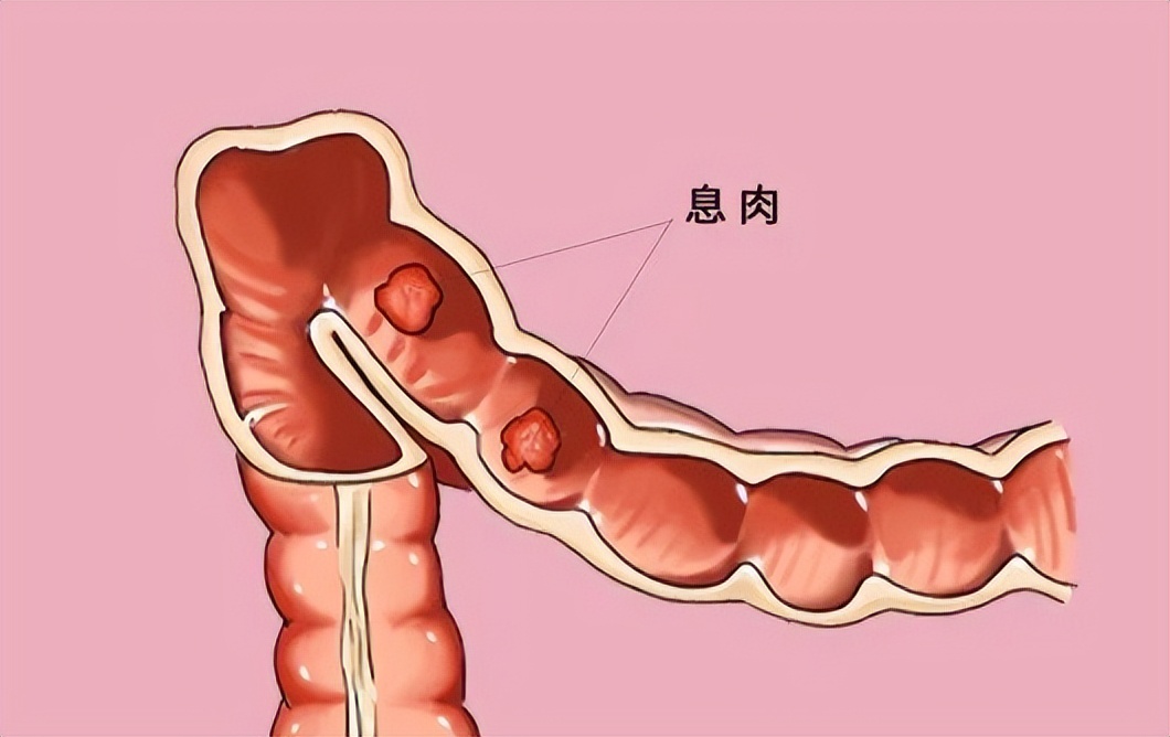 肠息肉有什么症状图片