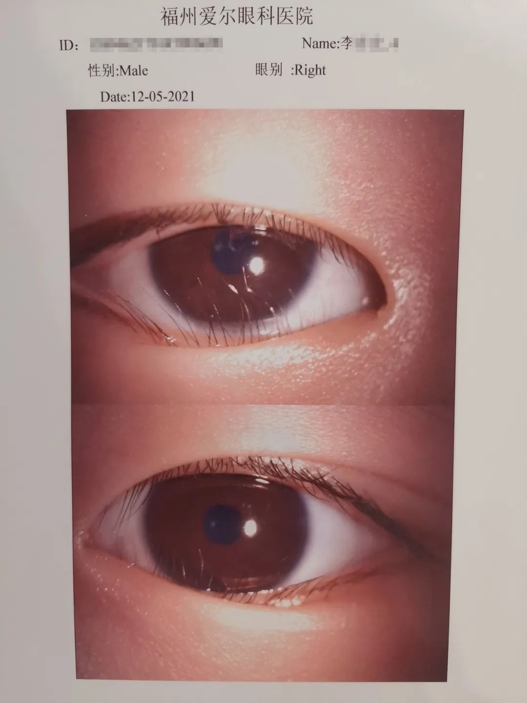 福州爱尔眼科医院成功为一五岁男孩进行眼部手术