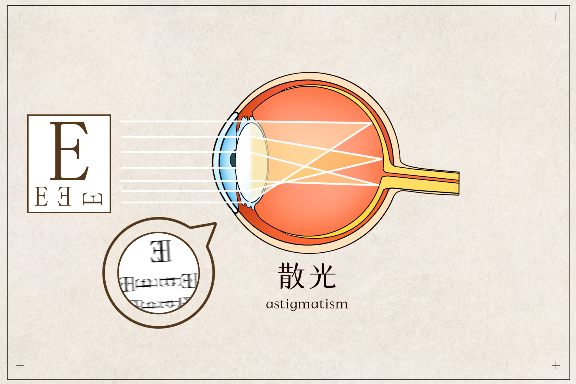 近視和散光可以矯正過來嗎|什麼是散光|散光的矯正方法有哪些