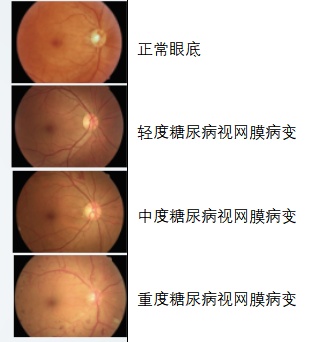 疾控話健康|防治糖尿病視網膜病變,從定期檢查眼底做起!