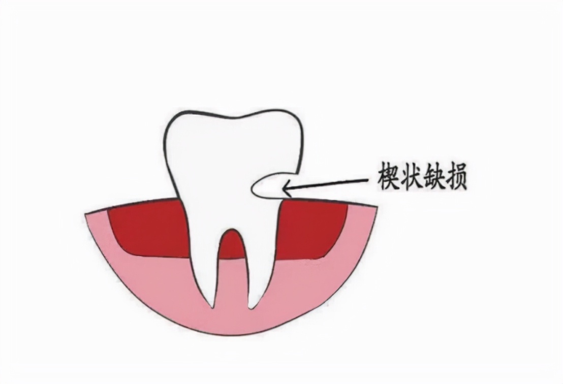 牙齿楔状缺损可以用电动牙刷吗?超级伤牙的四大误区!