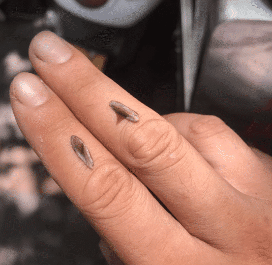 "手指上长了两根刺,去医院应该挂什么科?"建议揉揉眼睛再看!