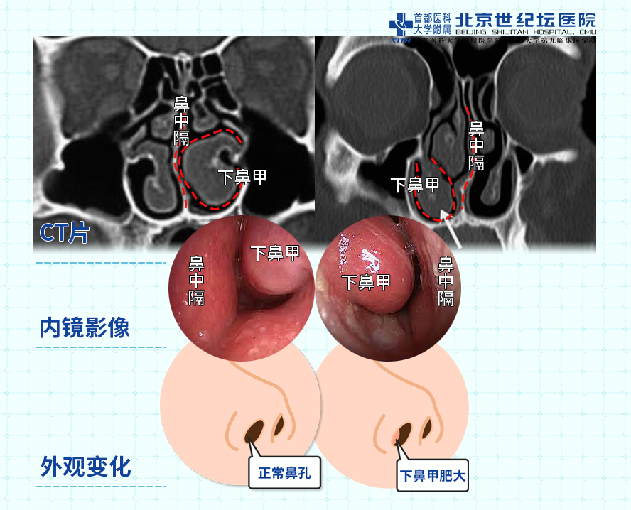 鼻腔内 正常图片