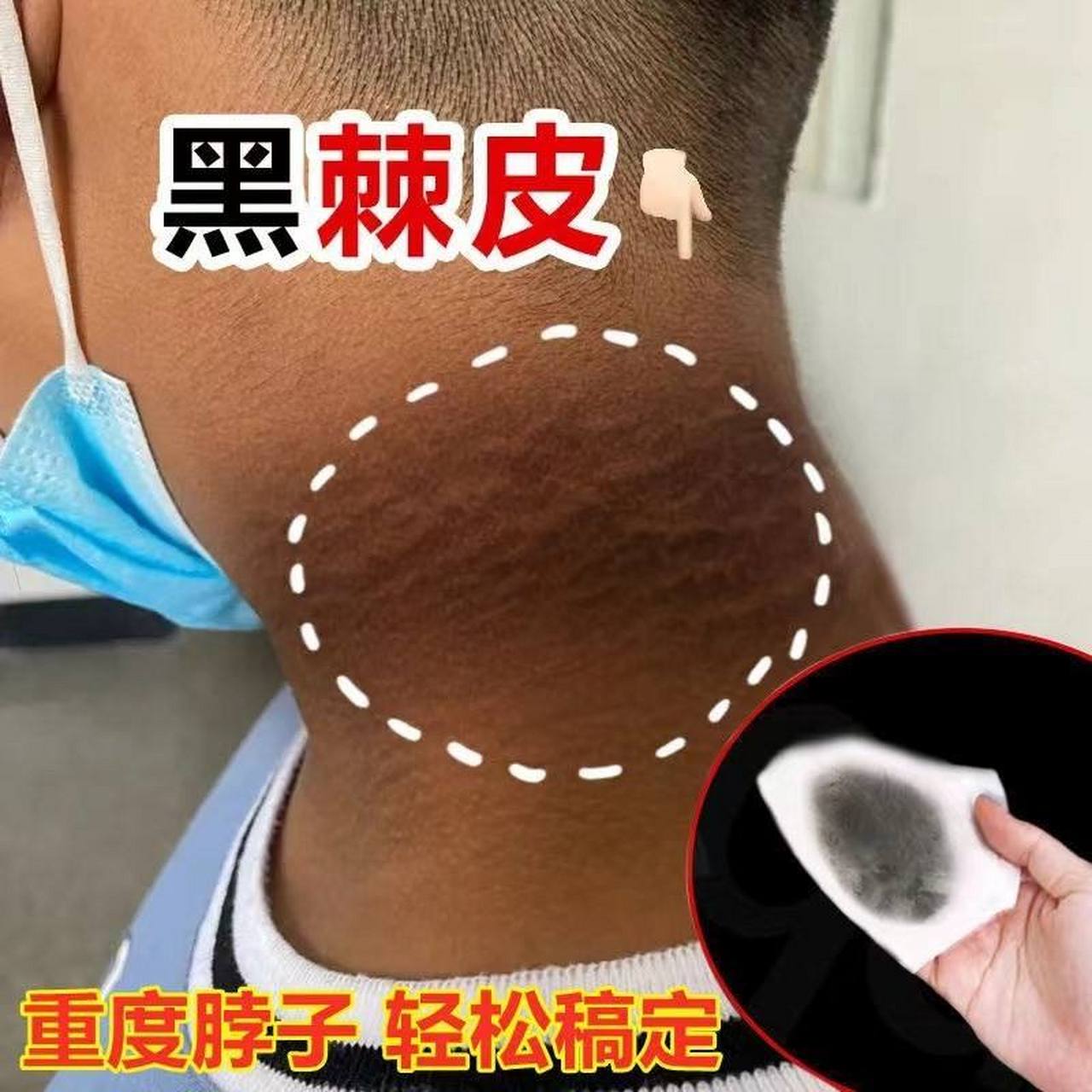 脖子黑色素沉着用什么方法可以去掉 脖子黑色素沉着是许多人在皮肤