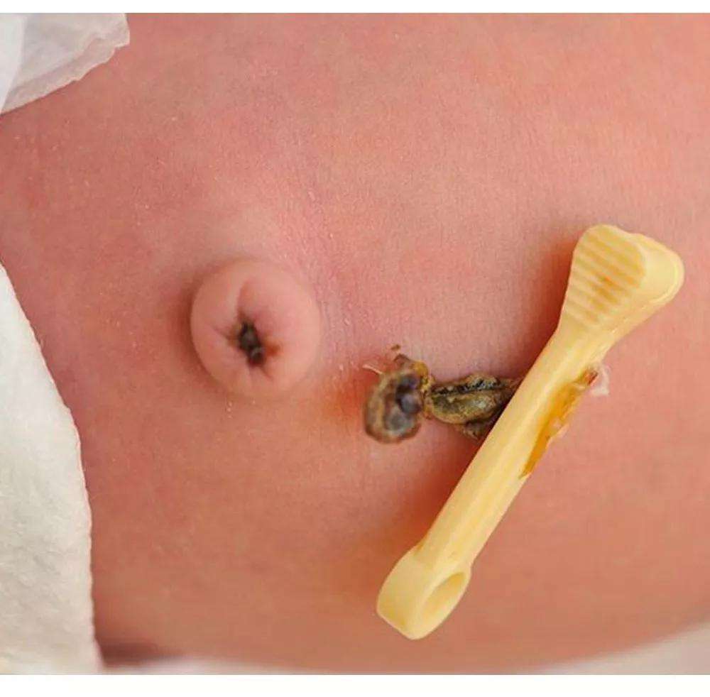 脐疝是指腹腔内容物由脐部薄弱区突出的腹外疝,婴儿发病率较高