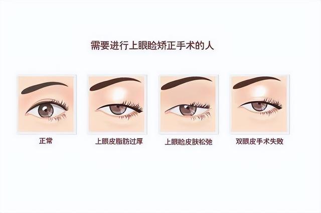 "眼睑下垂"该如何矫正?若是做上睑下垂矫正术,需要注意什么?