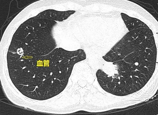 这个与血管相连的双肺多发小结节,是怎样的"神奇"疾病?