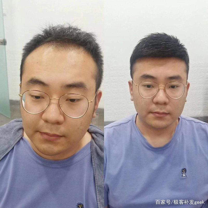 植发是植的假发么(植发植的是真发还是假发呀,能长吗)