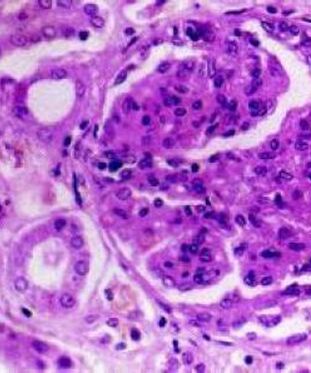 急进性肾小球肾炎,简称急进性肾炎,是肾小球肾炎中最严重的类型