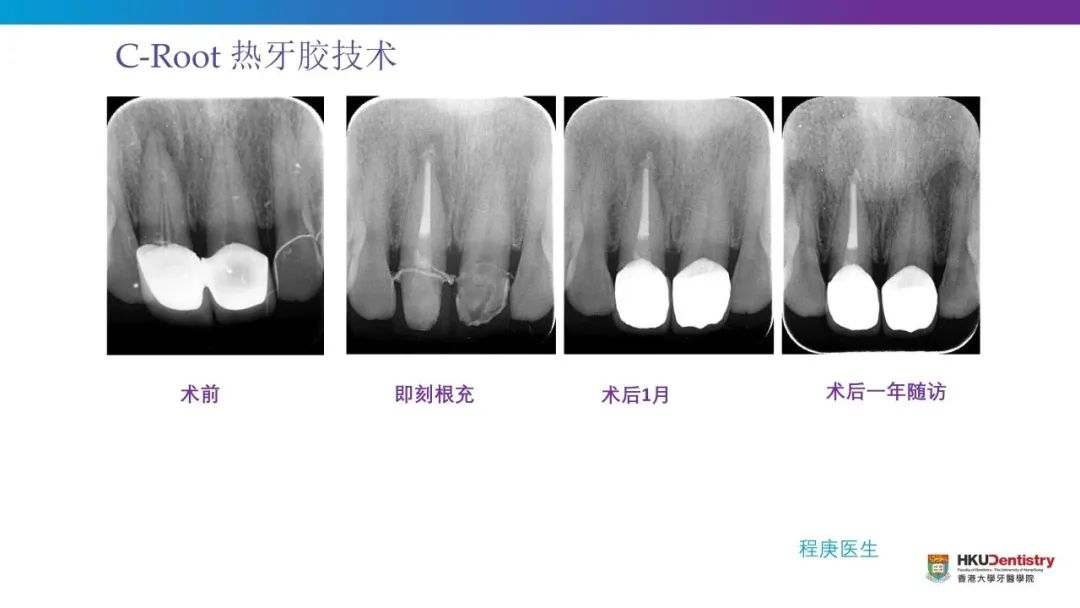 c-root sp根管充填案例集萃!锶生物陶瓷!