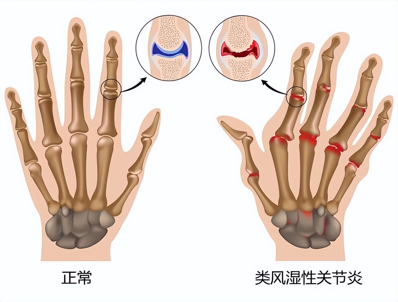 老年人手指僵硬