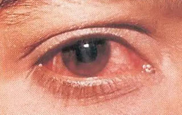 弓形虫病性巩膜炎是一种免疫炎性反应,多有眼红,眼球压痛的表现