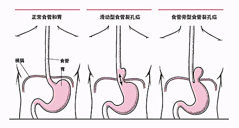 胃食管反流吃抑酸药不管用?这些情况可能要手术