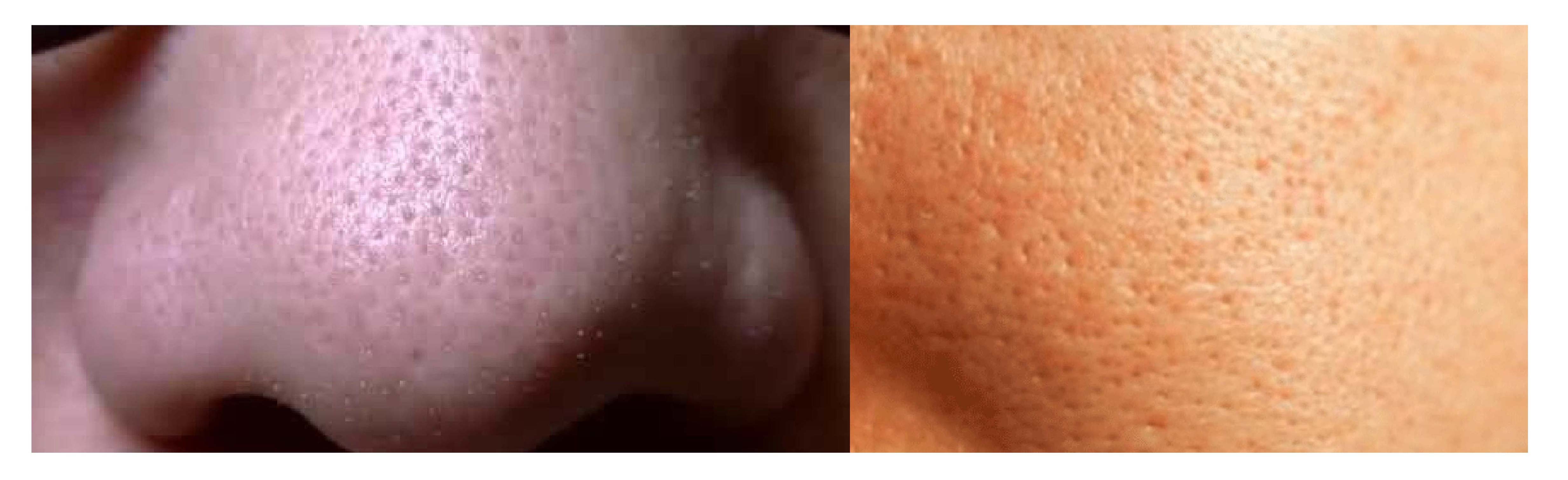 毛孔粗大有黑头怎么办 #医美科普挑战赛#  除了以上方法,我们还可以