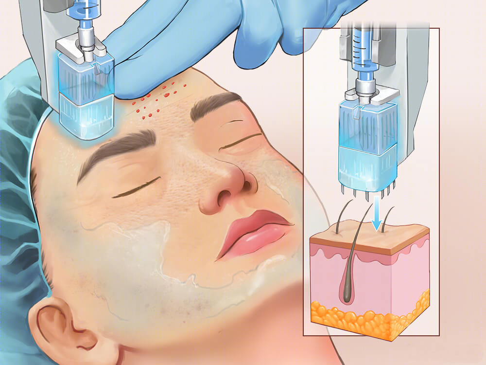 水光针是什么东西?有什么副作用吗?这些注意事项建议你了解一下