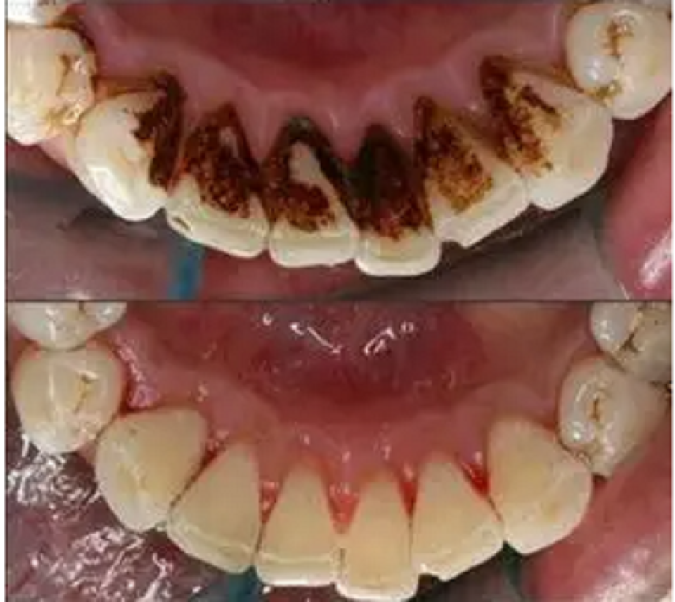 去除烟渍茶渍就这么简单!闲暇学会这几招,满嘴牙渍几天就能掉!