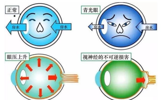 繼發性青光眼患者會出現眼部脹痛等症狀,術後需要給與恰當的藥物