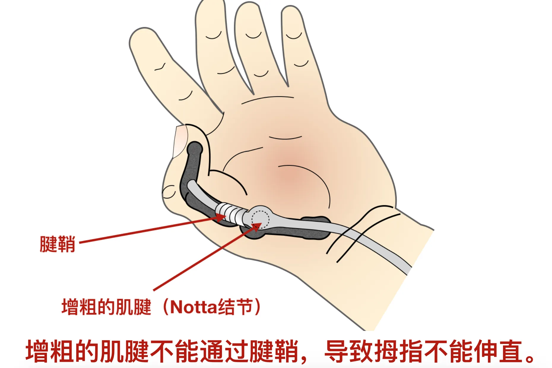 腱鞘炎怎麼治療最有效?選對方法不再花冤枉錢