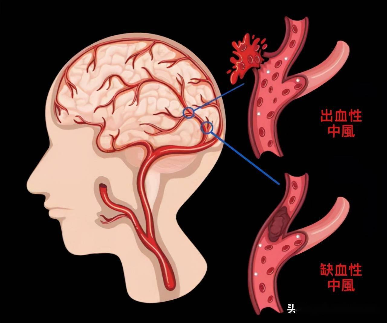 14岁男孩,不吸烟不喝酒,突发脑梗死!或与这个因素有关!