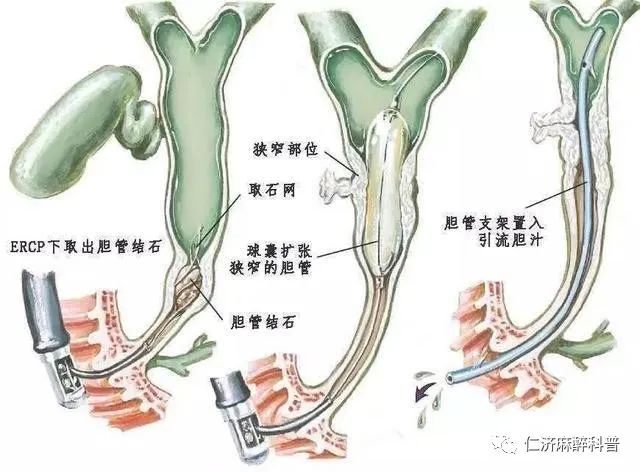 胆管癌的位置图片图片