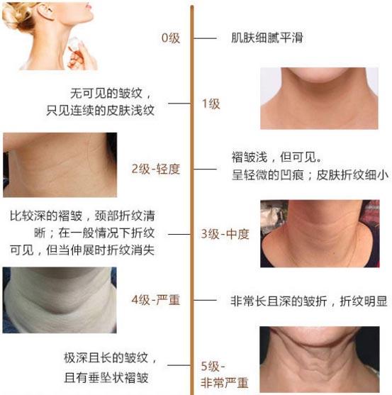 治疗颈部皱纹有哪些方法?又该如何预防颈部肌肤的老化问题?