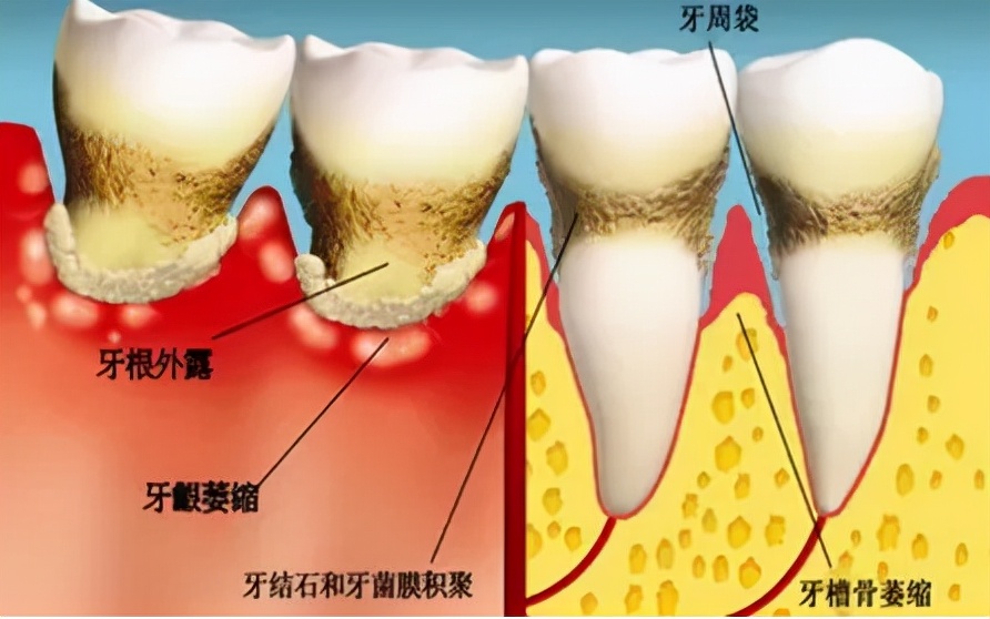 幹槽症是一種急性感染性疾病,發病時多在拔出牙齒之後出現